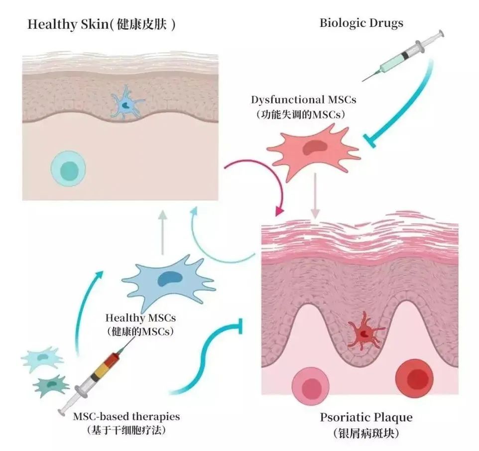干细胞最新临床结果再次证明！治疗银屑病有效率高达67%！