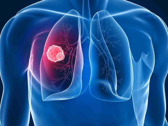 干细胞对抗肺部疾病，让一呼一吸不再艰难